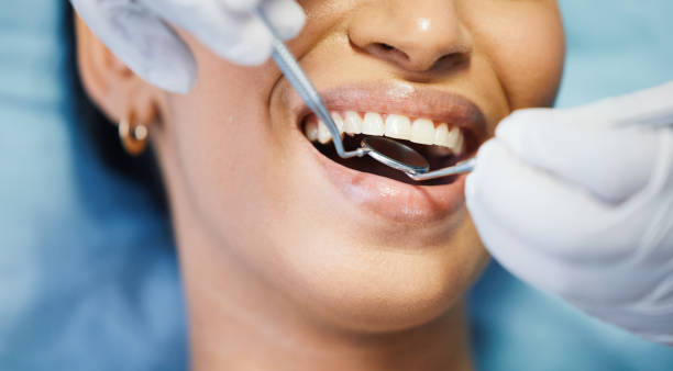 Best Knocked-Out Tooth (Avulsed Tooth) Treatment in Redlands, CA